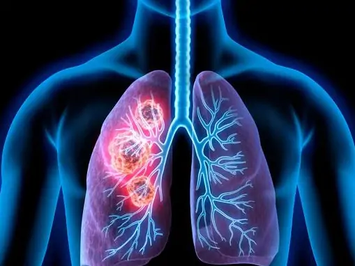 The benefits of hydrogen therapy in lung cancer The benefits of hydrogen therapy in lung cancer